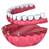 Immediate Load Implants Icon