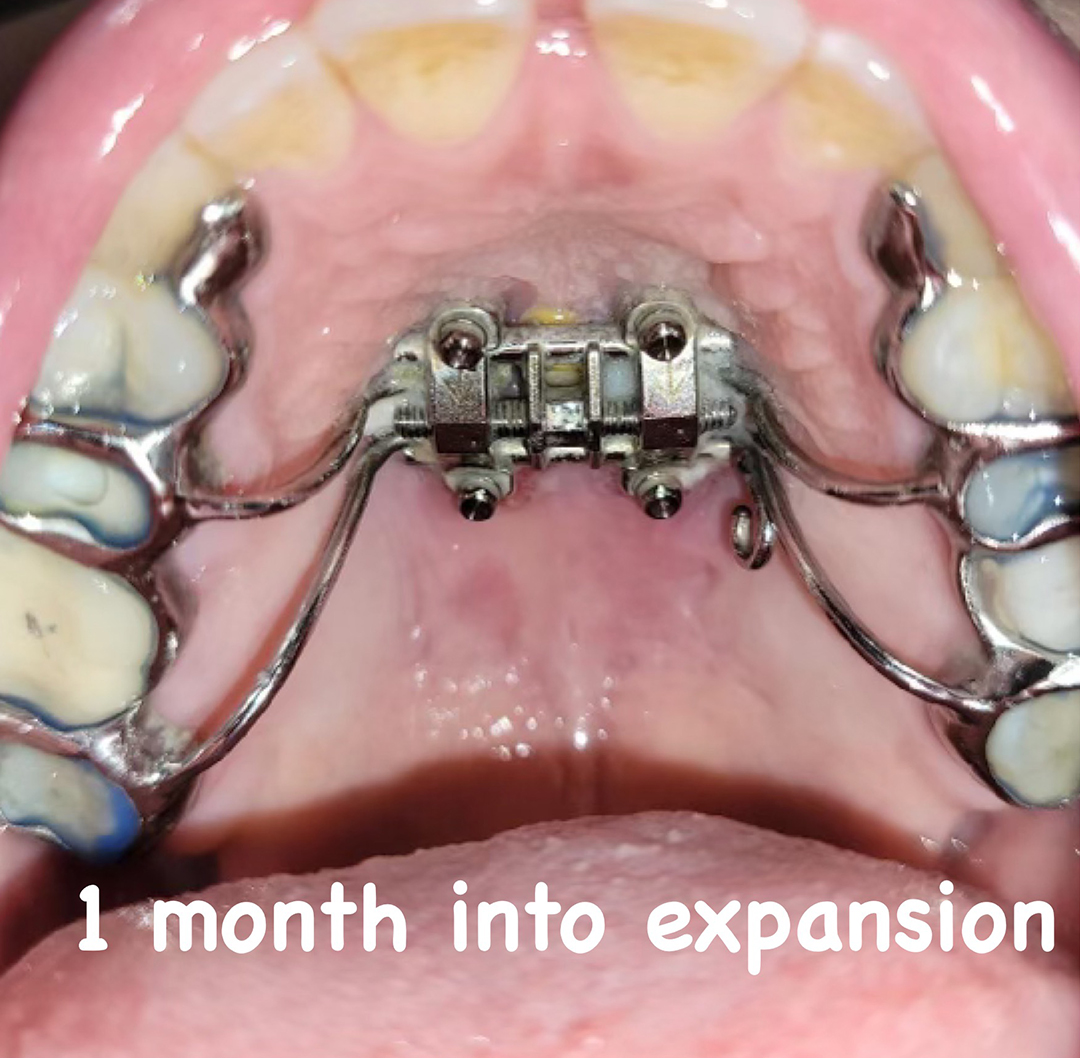 Maxillary Skeletal Expansion (MSE) | Dentist Arlington, VA