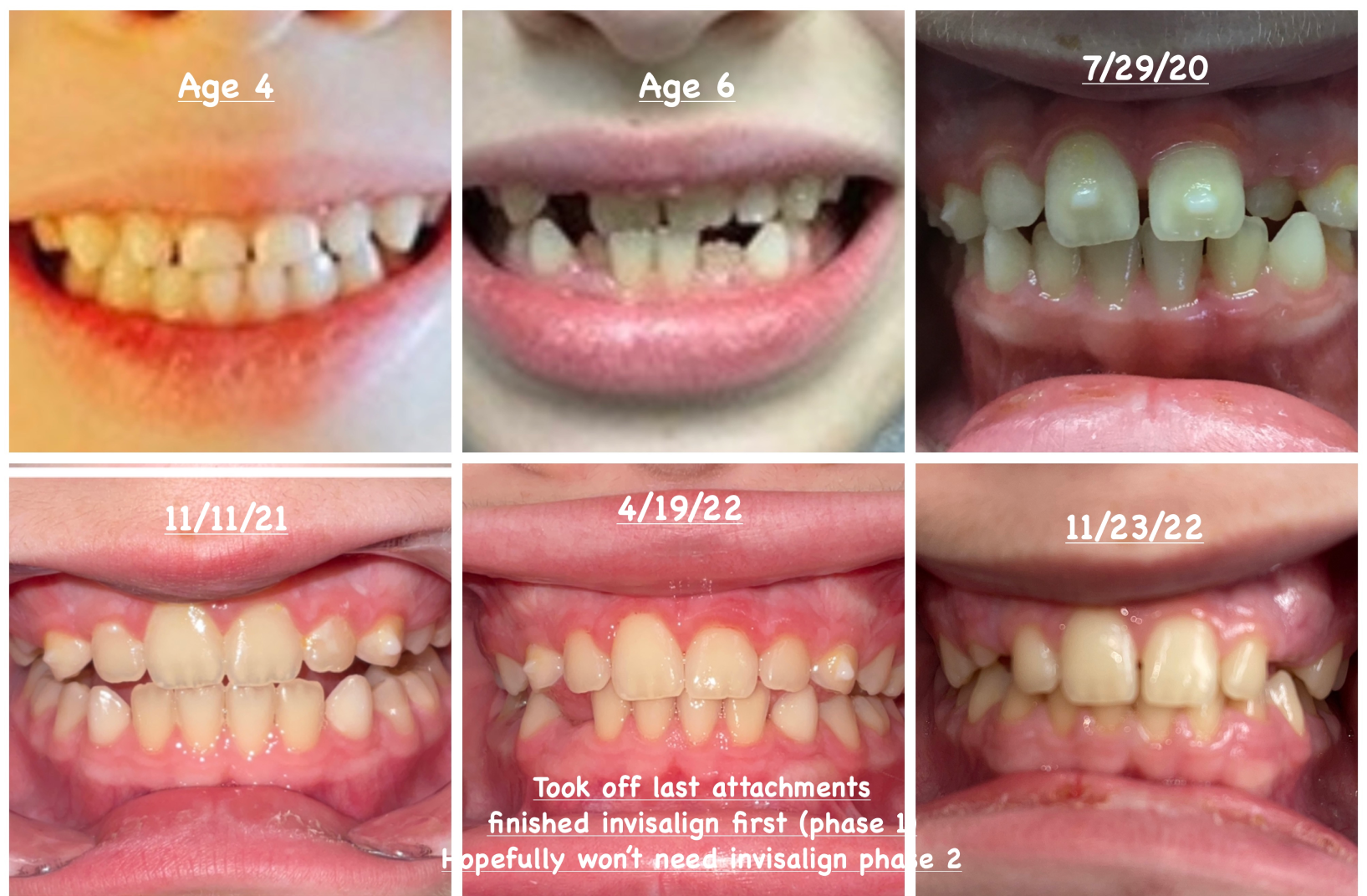 Is Invisalign Faster than Braces? l New England Kids Pediatric