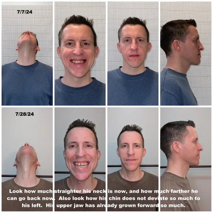 Image of a patient with multiple smile angles